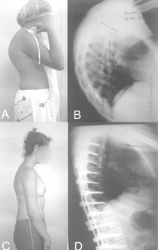 Sistema de parafusos pediculares no tratamento de deformidades vertebrais: análise da correção e das complicações imediatas 421 Figura 1 A) Paciente feminina, 13 anos, imagem pré-operatória.