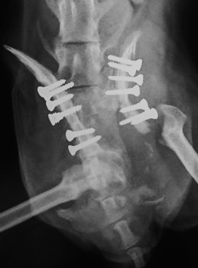 (setas); E) Imagem pós-operatória imediata do segundo procedimento cirúrgico onde visibiliza-se a exérese do acetábulo e