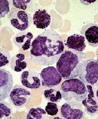 Tipos de Leucemia A leucemia pode ser: aguda avança rapidamente com muitas células cancerosas imaturas. crônica avança lentamente com células leucêmicas de aspecto mais maduro.