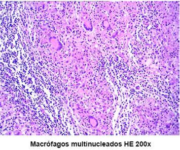 órgãos e constituem o Sistema Fagocitário Mononuclear Nomes especiais Fígado célula de Kupffer SNC célula da micróglia Pele célula de