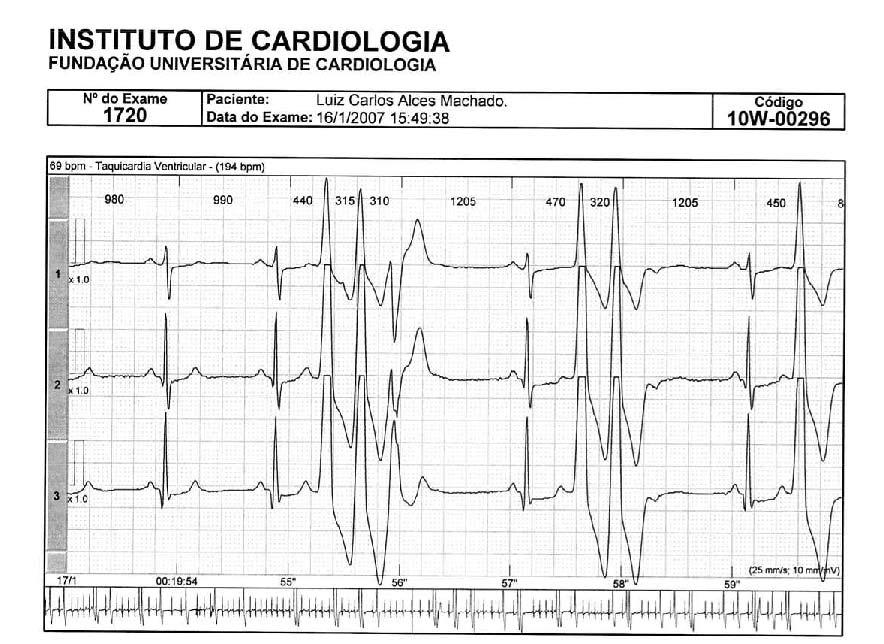 2 Figura 1 - Traçado de Holter de paciente