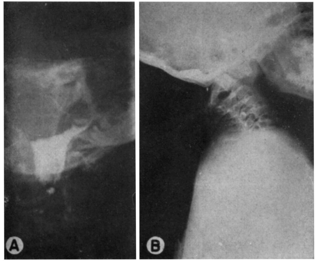 Em 3 dos casos, a iodoventriculografia mostrou que o quarto ventrículo transpassava o buraco occipital (fig.