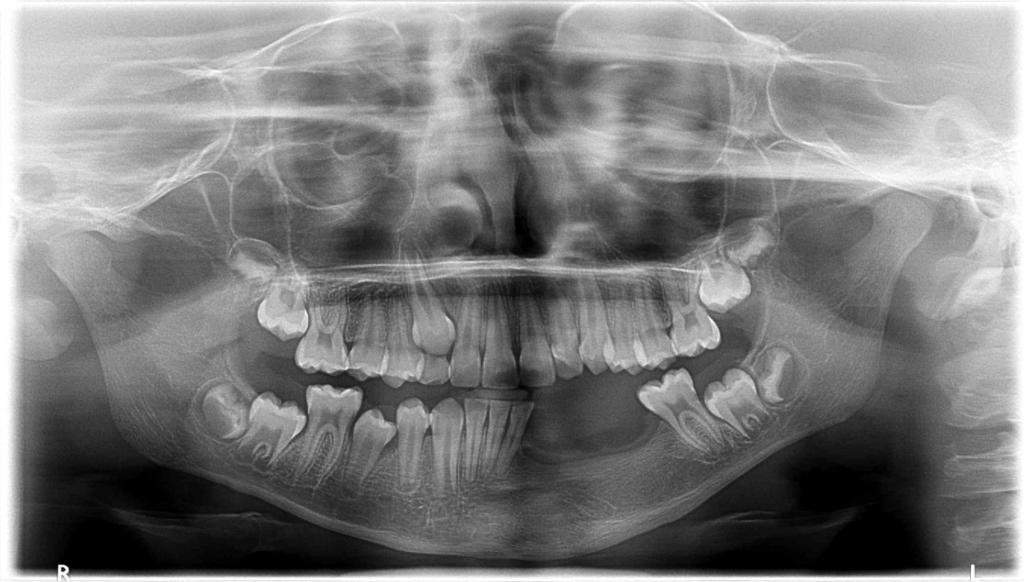 Um período de quatro meses foi aguardado, entretanto, a lesão também não respondeu clinica e radiograficamente, implicando na necessidade de tratamento cirúrgico.