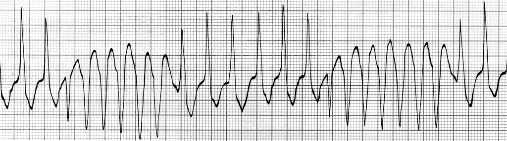 TORSADE DE POINTES TÍPICA (TdP) AQRS de TV muda 180 0 padrão ondulante ou aparência de torsão das pontas do QRS de 180 0 Qualidade sinusoidal na mudança a na forma do QRS A