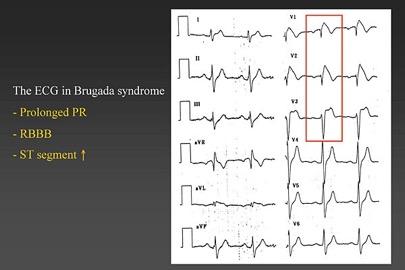 ECG - Bloqueios de Ramo Alterações 1 as e 2 as podem coexistir ou Inversões ondas T nas derivações precordiais dtas c/ BRE Inversões ondas T nas derivações précordiais esq c/ BRD Marcadores de