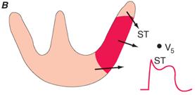 cavidade ventricular Infra ST Isquemia