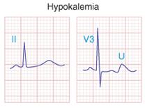 ECG - Fatores Metabólicos e efeitos de fármacos HipoK: Prolonga a repolarização ventricular - Ondas U proeminentes Prolongamento intervalo QT!