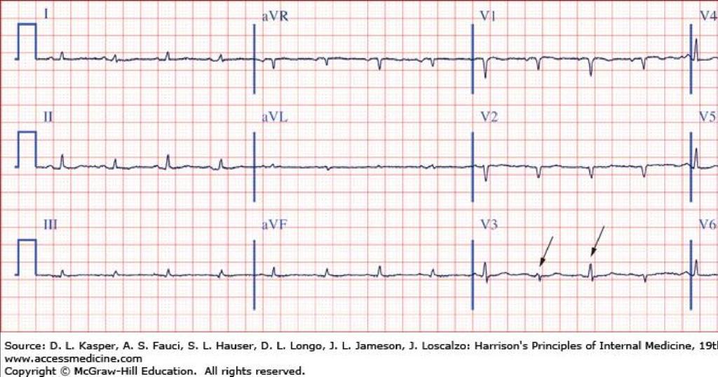 ECG - Tríade clássica de derrame pericárdico com tamponamento: 1.