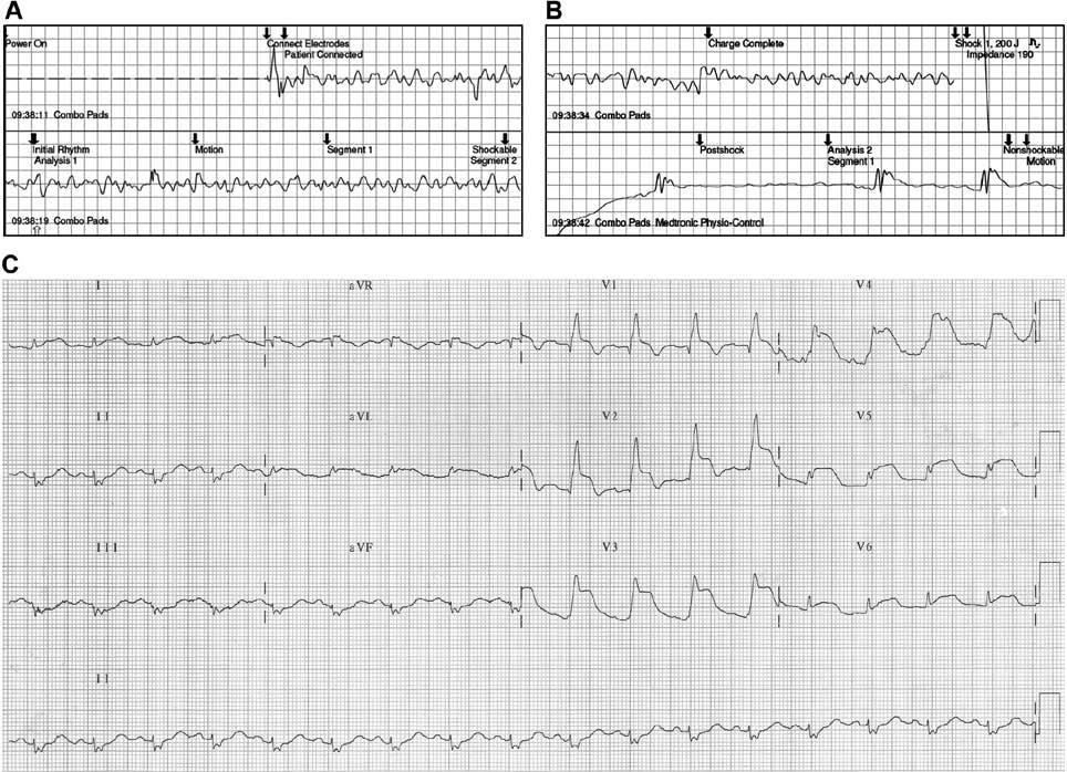 Parada cardíaca causada por infarto agudo do miocárdio durante atividade esportiva INTRODUÇÃO A doença arterial coronariana (DAC) é a causa mais freqüente de morte nos Estados Unidos, sendo