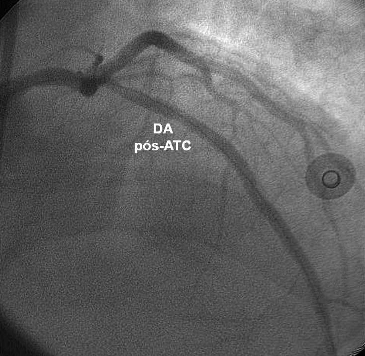 O ecocardiograma transtorácico mostrou acinesia apical, anterior e septal, com 40% de fração de ejeção do ventrículo esquerdo (método de Simpson).