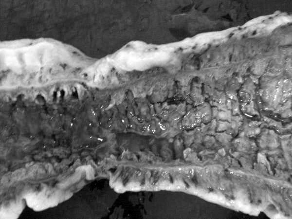 À cirurgia havia 300 ml de líquido seroso livre na cavidade abdominal e isquemia mesentérica com comprometimento de íleo e ceco.