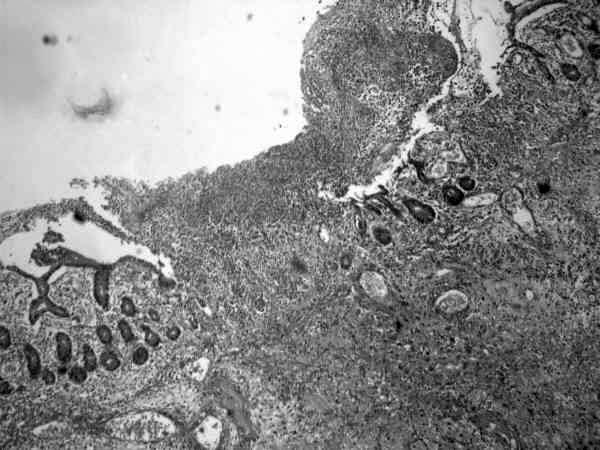 O estudo anatomopatológico evidenciou peça cirúrgica representada por 78 cm de intestino delgado, ceco e gordura mesentérica. A serosa estava pardacenta e lisa.