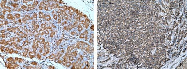 Expressão de Cyr61 em glândulas mamárias normais e neoplásicas de cadelas. 1369 Figura 1 - A) Adenoma simples de glândula mamária de cadela. Marcação acentuada no citoplasma das células epiteliais.