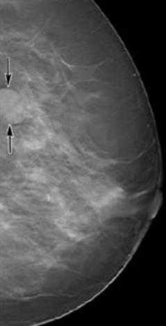 et al (2007): "Breast Tomosynthesis: Present