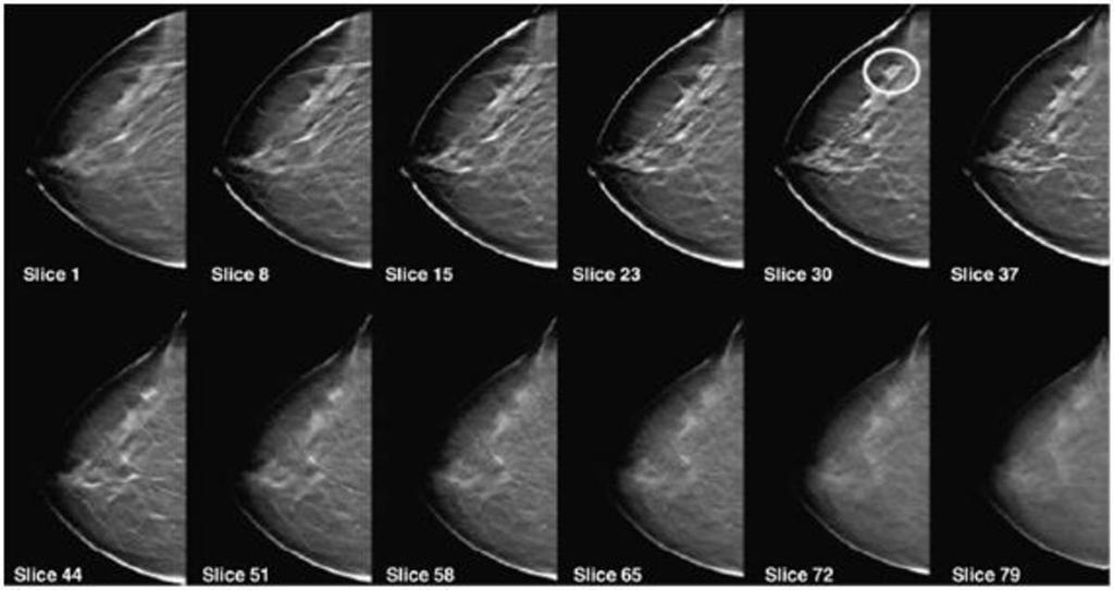 Tomossíntese Digital da Mama Carcinoma Lobular invasivo corte 30 Schulz-Wendtlanda R.
