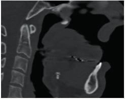 Key-words: Mandible; Jaw Neoplasms; Masticatory Muscles; Finite Element Analysis; Jaw Fixation Techniques.