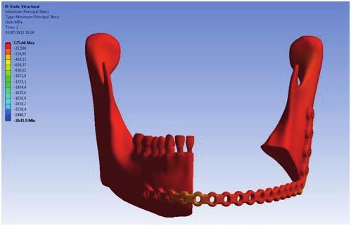 Figura 3 - Tensão no complexo mandibular.