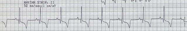 5 QUESTÃO 8- Calcule a frequência cardíaca com base no traçado eletrocardiográfico apresentado (sensibilidade n e velocidade de 50mm/s) e assinale a alternativa correta: (A) Aproximadamente 60