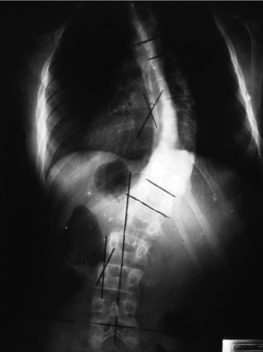 Rodrigues LMR, Yonezaki AM, Ueno FH, Nicolau RJ, Abreu LC, Santiago Filho EV, César AEM Figura 1 Radiografia no plano frontal pré-operatória com ângulo de Cobb na curva torácica principal de 52.