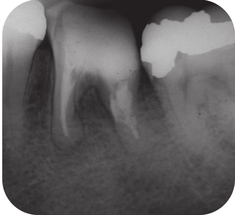 controle que sucedem a obturação do canal radicular demonstram o reparo ósseo periapical e na região de furca da unidade dental em