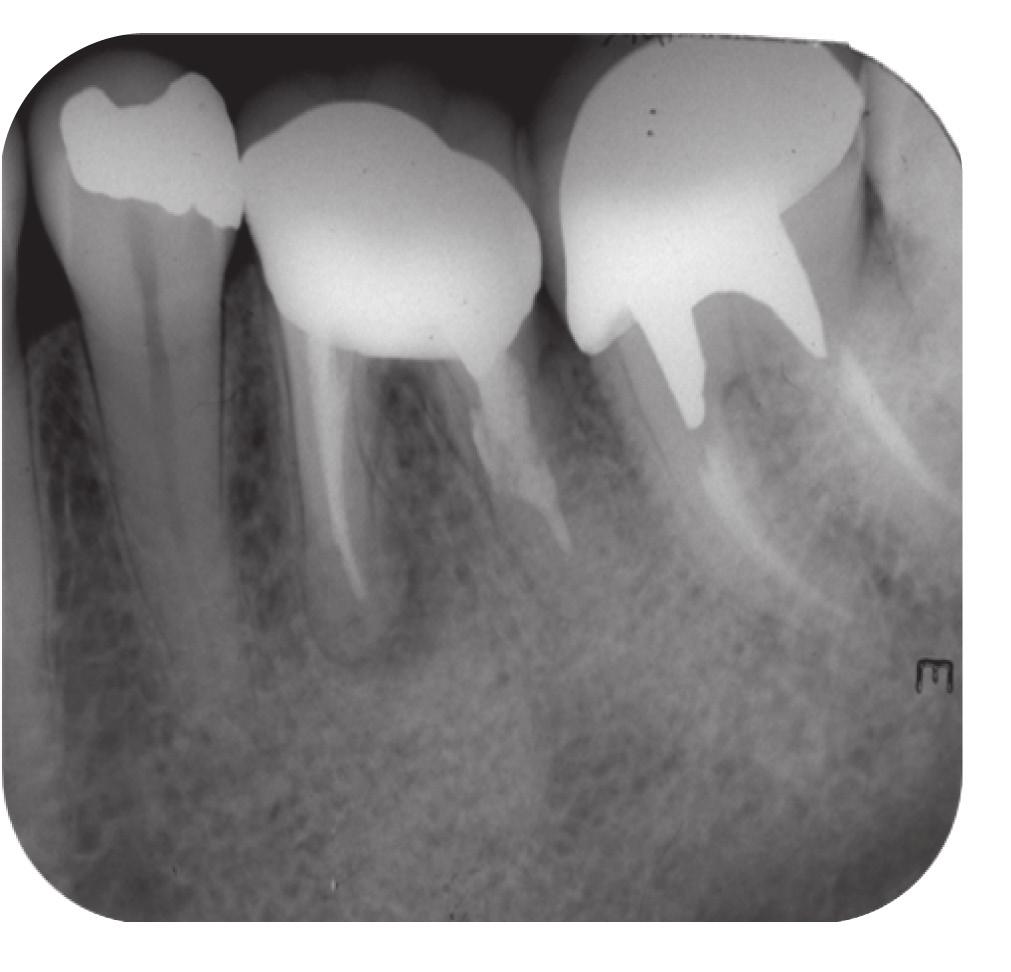 traumatismos, como a concussão, considerada trauma muito leve, onde o dente permanece dolorido por algumas horas e sem qualquer