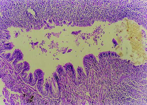 Marchiori E et al. Figura 2. Em, TCR evidenciando espessamento irregular do interstício peribroncovascular, predominando na sua porção axial.