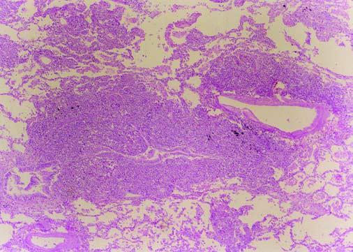 C DISCUSSÃO Embora os linfomas pulmonares possam ser classificados em diversos grupos, as manifestações radiológicas pulmonares se superpõem em todas as formas da doença (1), tanto nos LH como nos