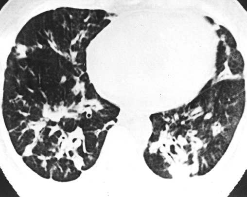 Linfomas pulmonares: correlação da TCR com a anatomopatologia C D E Figura 3.