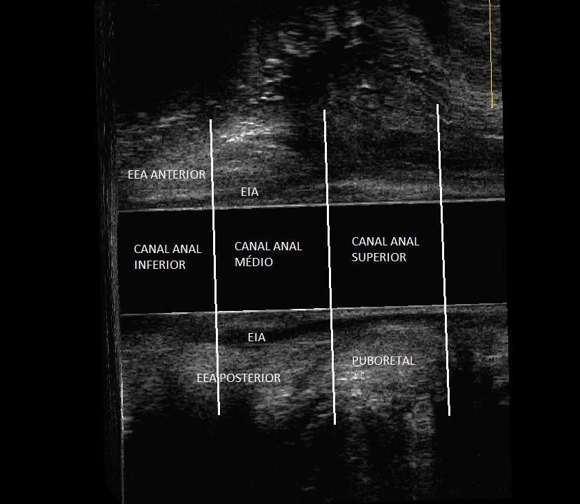 30 Figura 5. Divisões do canal anal anal em corte sagital do cubo de captura. EEA=esfíncter externo do ânus, EIA=esfíncter interno do ânus. Fonte: arquivo do pesquisador.