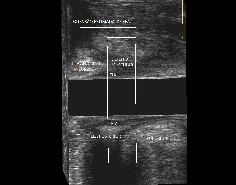 40 Figura 16. Aspecto ultrassonográfico da medida da porcentagem de defeito de esfíncter externo do ânus em plano sagital relativa à extensão longitudinal estimada de esfíncter sadio.