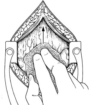 Cologna AJ.. 2.3.6 Descolamento da gordura perivesical e peritônio (manobra de Guyon).