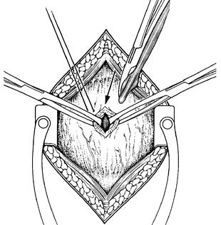 8 Abertura da bexiga Traciona-se levemente os dois fios de categute e procede-se a abertura da parede vesical (incisão de 1 cm ou o suficiente para passagem do