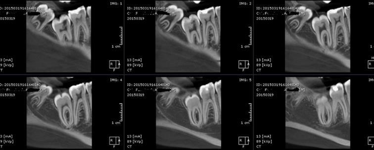 Figura 4- Tomografia Cone Beam- Corte Sagital Figura 5- Tomografia Cone Beam - Corte Transversal Quando comparado com a primeira radiografia panorâmica, não foi observada a evolução significativa da