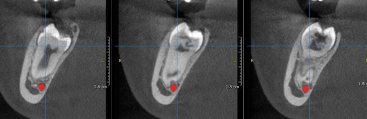 Segundo a análise da Tomografia Cone Beam, observou-se a ruptura mesial do dente e que em todo o tempo o dente se encontrava subgengival, sem contato aparente com fluidos bucal, consequentemente não