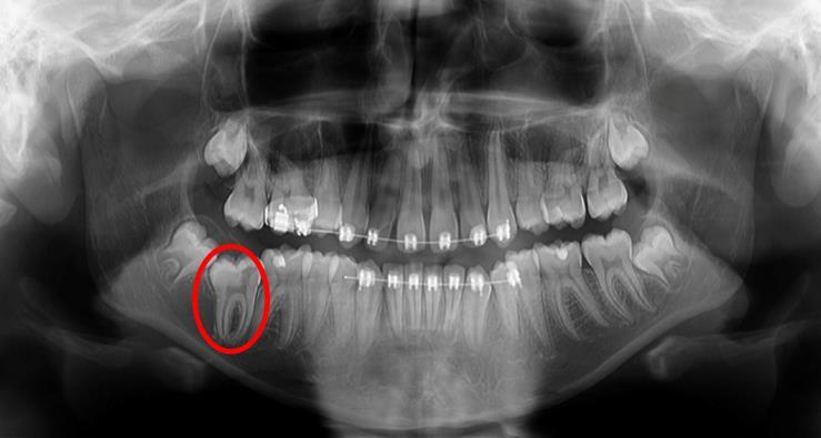Figura 2- Radiografia Panorâmica (3 anos após a 1ª Radiografia Panorâmica) Durante esse período de três anos que se passou, o 2º molar inferior direito possivelmente sofreu uma impactação pela