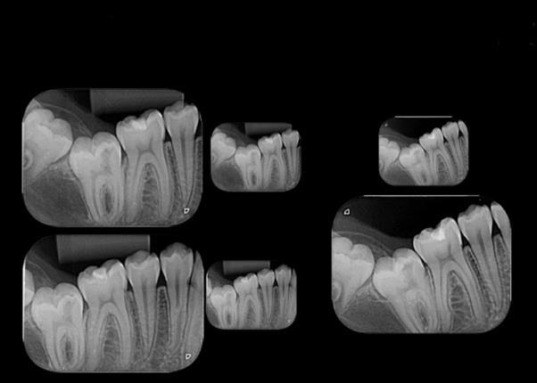 Após esse achado radiográfico, foi solicitada a realização de uma radiografia periapical (Figura 3) para reforçar o diagnóstico e verificou-se com esta, uma área radiolúcida na região mesial que se