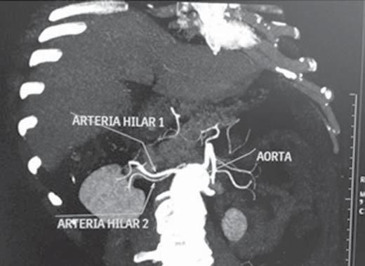 Figura 5. TCMD, reconstrução MIP coronal oblíqua. Visualiza-se a artéria hilar principal direita, nomeada de artéria hilar 1, e uma artéria hilar acessória direita, nomeada de artéria hilar 2.