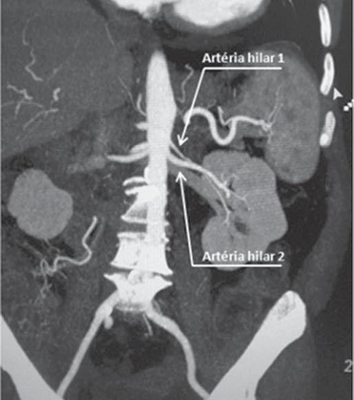 variações (Figura 7), visto que em artérias com diâmetro menor que 3 mm a anastomose é difícil e há maiores riscos de trombose; b) ao comprimento da artéria de sua origem até sua primeira bifurcação
