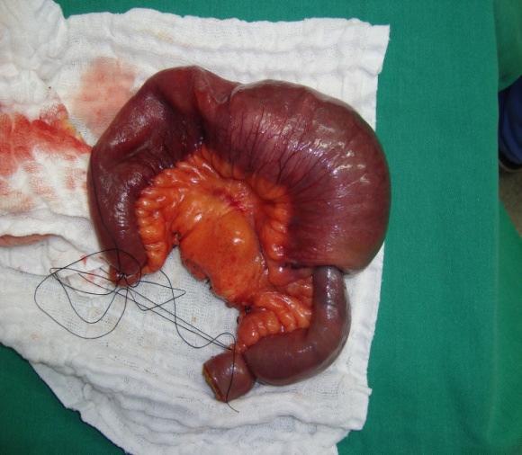 parede intestinal a neoplasia infiltra a parede formando ninhos e massas de células epitelióides atípicas (na imagem, ocupa os dois terços inferiores, com o