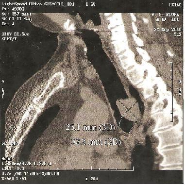 com croça da aorta e esôfago torácico (Figuras 1A e 1B). Endoscopia digestiva alta normal.