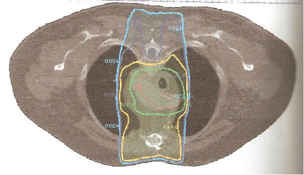 O estudo anatomopatológico da peça cirúrgica revelou carcinoma adenoide cístico e a margem brônquica esquerda estava microscopicamente envolvida pelo tumor.