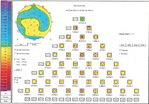Aberrometria Corneana na Trissomia 21 aberrações corneanas, com base em coeficientes de Zernike (figura 1).