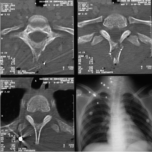 328 Amato MCM, Santos MV, Weltson A, Oliveira RS, Boullosa JLR Figura 3 Cortes axiais de TC da janela óssea mostrando projétil paravertebral e fratura do processo espinhoso da primeira vértebra