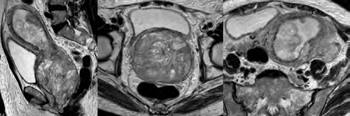 gadolínio (c) revela volumoso tumor do endométrio, com invasão da metade exterior do miométrio e extensão à serosa.