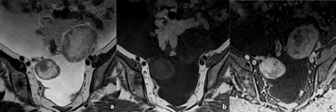 e captação moderada de contraste, compatível com tumor de Brenner (setas). avançado: lesões quísticas complexas em ambos os ovários, acompanhadas de ascite e implantes peritoneais (fig. 27).