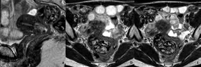 de forma a minimizar o preenchimento da ampola rectal e cólon sigmóide.