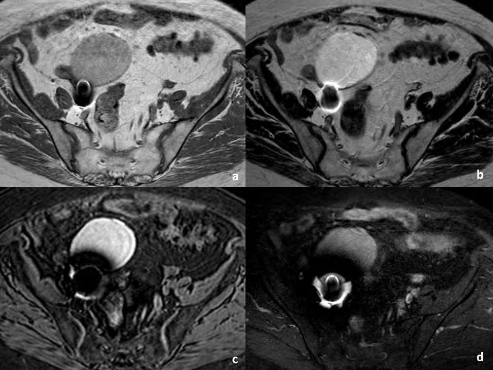 Figura 5 Mulher de 70 anos de idade, com cistadenofibroma do ovário direito e antecedentes de nefrectomia direita com laqueação do ureter homolateral.