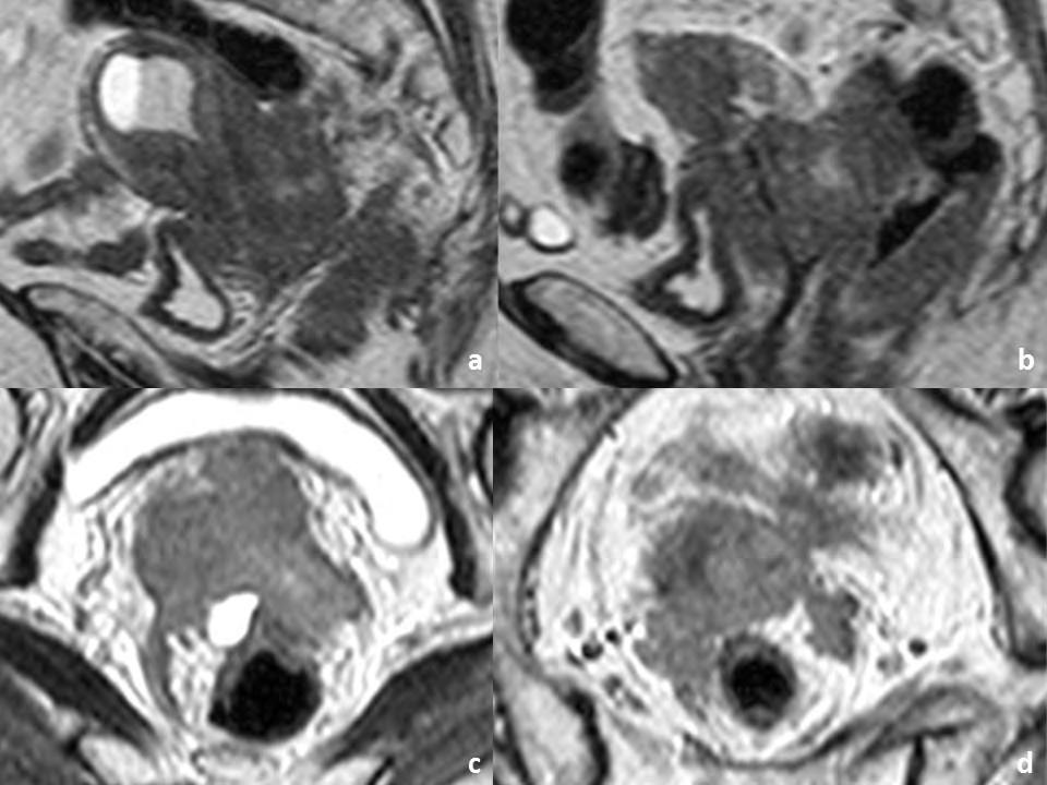 mucosa e presença de tumor no lúmen vesical (seta). Estes achados determinam o estádio IVA da FIGO.