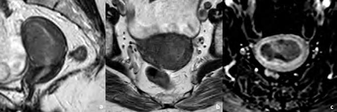 cavidade endometrial preenchida por volumoso tumor polipóide do endométrio. A profundidade de invasão miometrial parece atingir a metade exterior (seta), sugerindo um estádio IB.