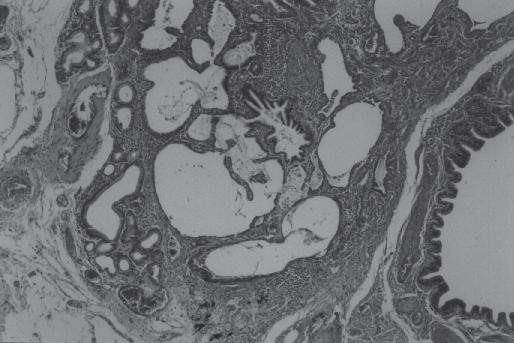 No final da 2ª semana fibroblastos podem ser observados junto às membranas hialinas, ocorrendo sua redução bem como do edema e da hemorragia.